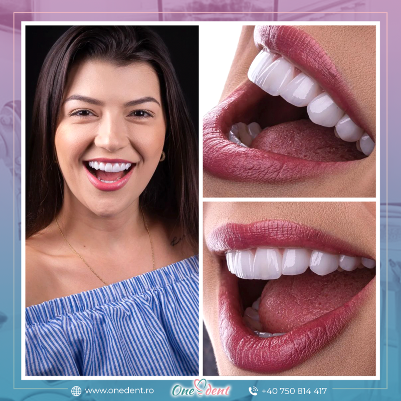 gingivectomie laser Iasi