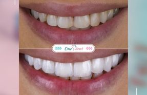 boala gingiilor Iasi